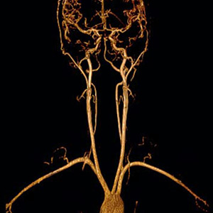 Angio Risonanza Magnetica