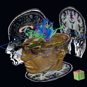 Risonanza Magnetica Cervello