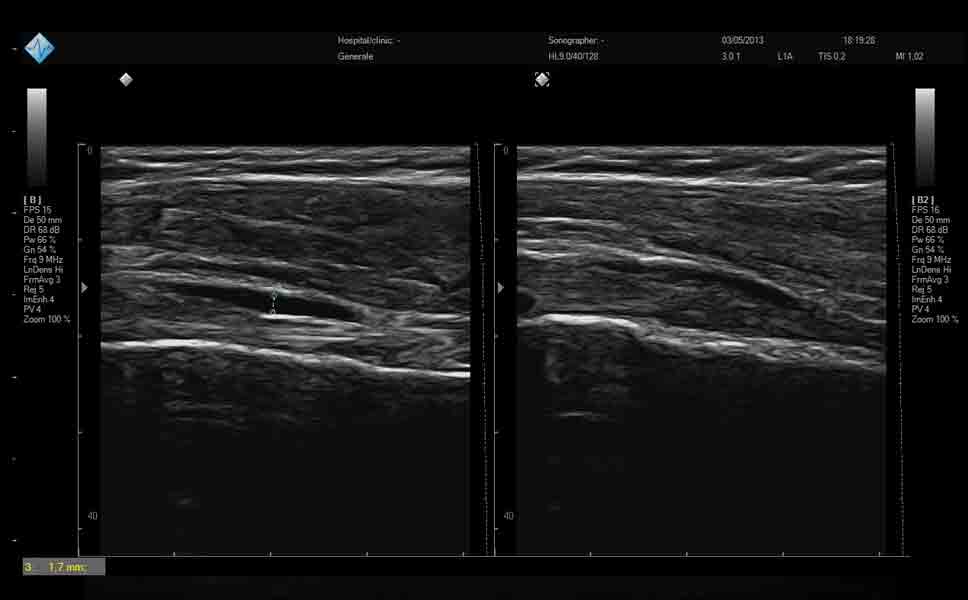 Ecografia muscolo tendinea