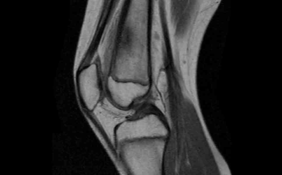 Immagine di una risonanza magnetica del ginocchio