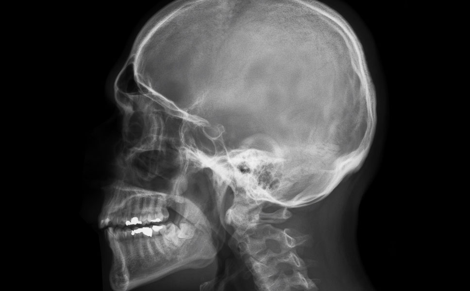 Radiografia del cranio