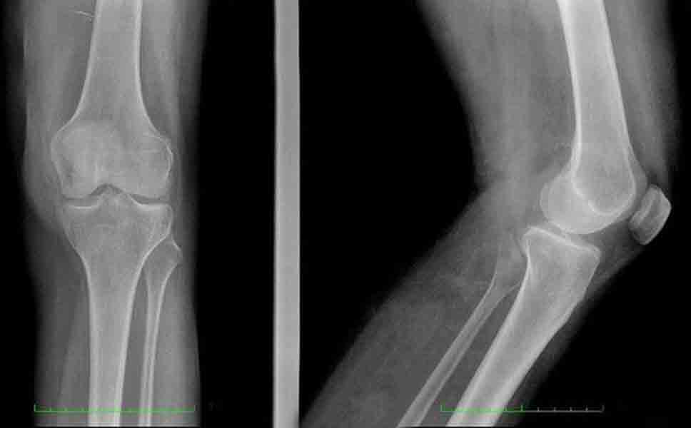 Immagine di una radiografia del ginocchio