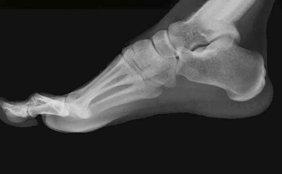 Radiografia del piede