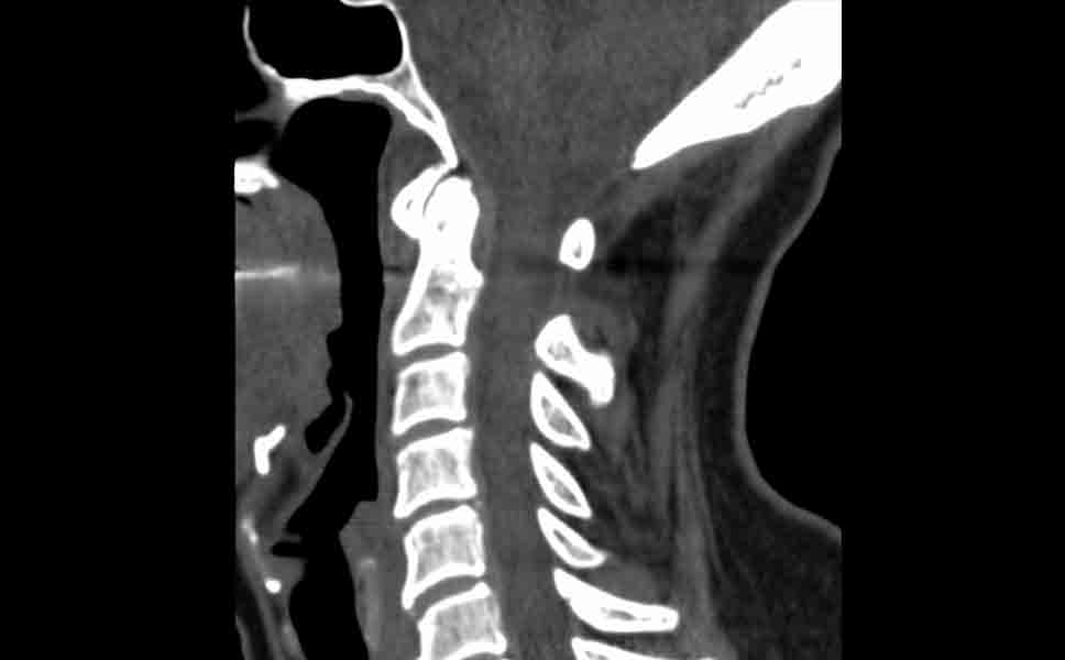 TAC cervicaleTAC cervicaleTAC cervicale