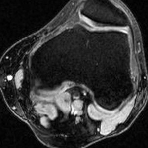 Risonanza Magnetica Aperta Ginocchio