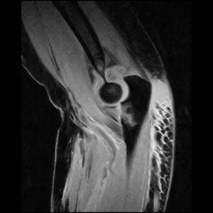 Risonanza Magnetica Aperta Gomito