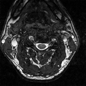 Risonanza Magnetica Aperta Colonna Cervicale