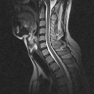 Risonanza Magnetica Aperta Colonna Cervicale