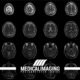 La risonanza magnetica encefalo nella diagnosi della sclerosi multipla