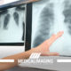 Focolaio polmonare: cos’è, sintomi e quanto dura