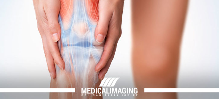 Sinovite del ginocchio: cause, sintomi e cura