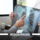 Edema polmonare: cause, sintomi e cura